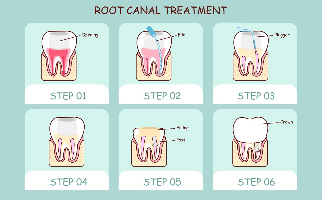What Is Root Canal