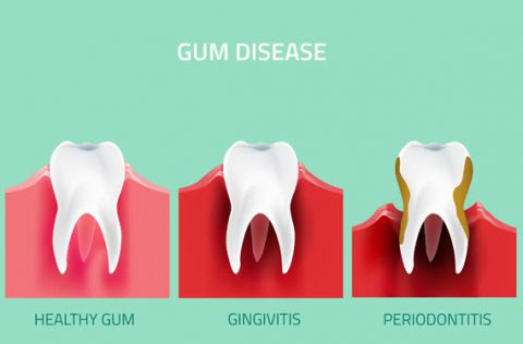 Gum Disease in New Mexico