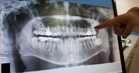 dental x-ray safety